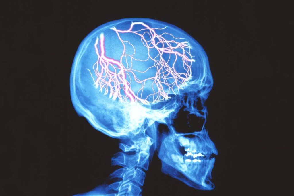 Migraine drug that treats headache also eases symptoms like dizziness